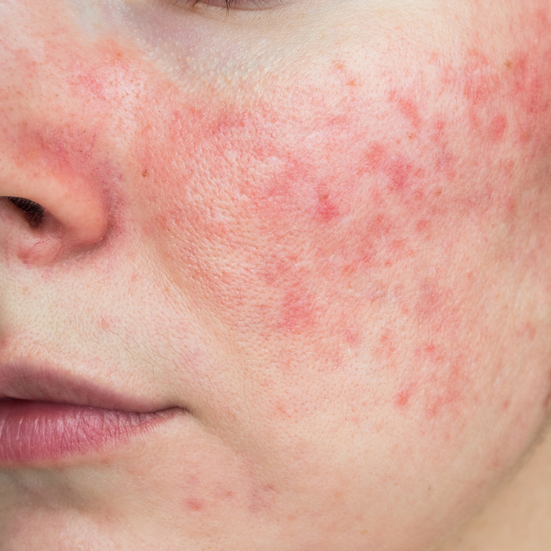 Managing Rosacea: Three Key Ways to Keep Skin Calm and Comfortable