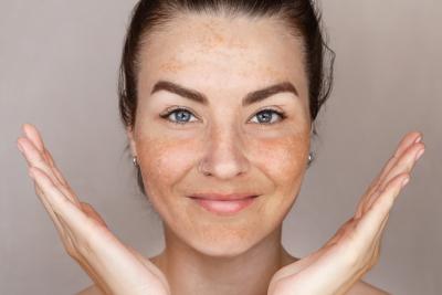 Understanding Hyperpigmentation: What It Is and How to Help Manage It