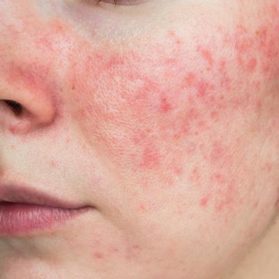 Managing Rosacea: Three Key Ways to Keep Skin Calm and Comfortable